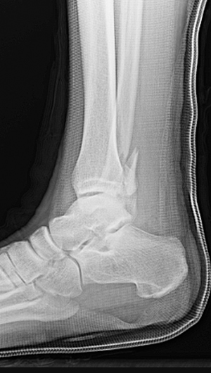 Broken Fibula